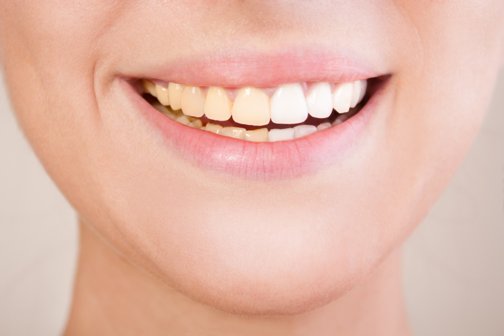 person smiling and showing their teeth